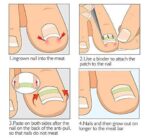 Dedicated Ingrown Nail Orthodontic  Correction Patch Inflammation Manicure Clippers - Image 4
