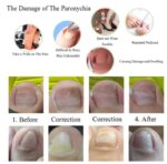 Dedicated Ingrown Nail Orthodontic  Correction Patch Inflammation Manicure Clippers - Image 2